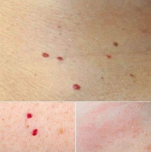 RED DOTS ON YOUR SKIN CAUSES AND WHAT THEY MIGHT REPRESENT My Blog